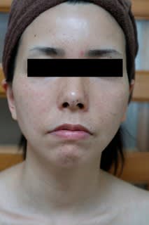 【実験結果】顔筋リリースフルコース（その１）